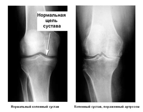 артроза на колянните стави 1 - 2 степени на лечение
